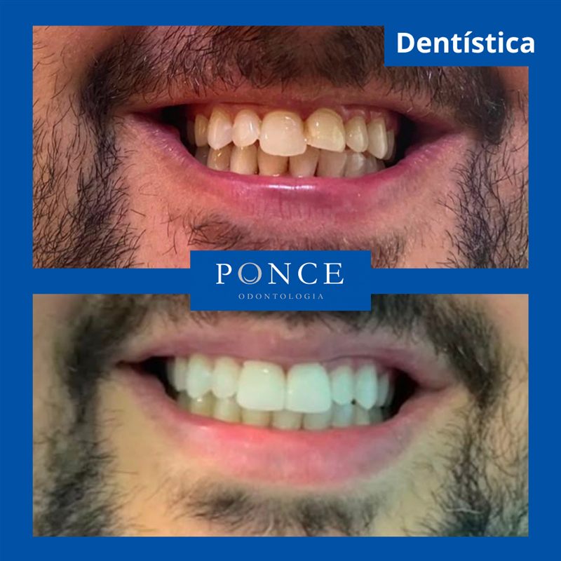 Antes e depois de tratamento de dentística realizado pela Dra. Raquel Ponce em Niterói