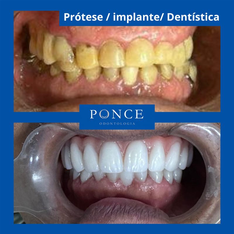 Antes e depois de reabilitação com prótese, implante e dentística pela Dra. Raquel Ponce em Niterói